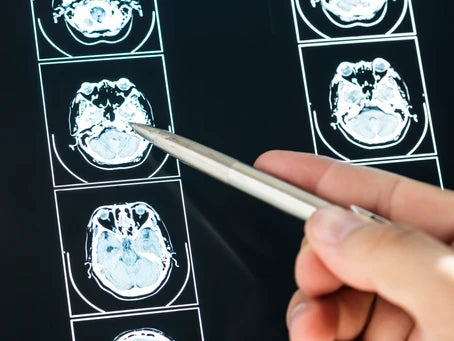 Promising Treatment for Traumatic Brain Injury